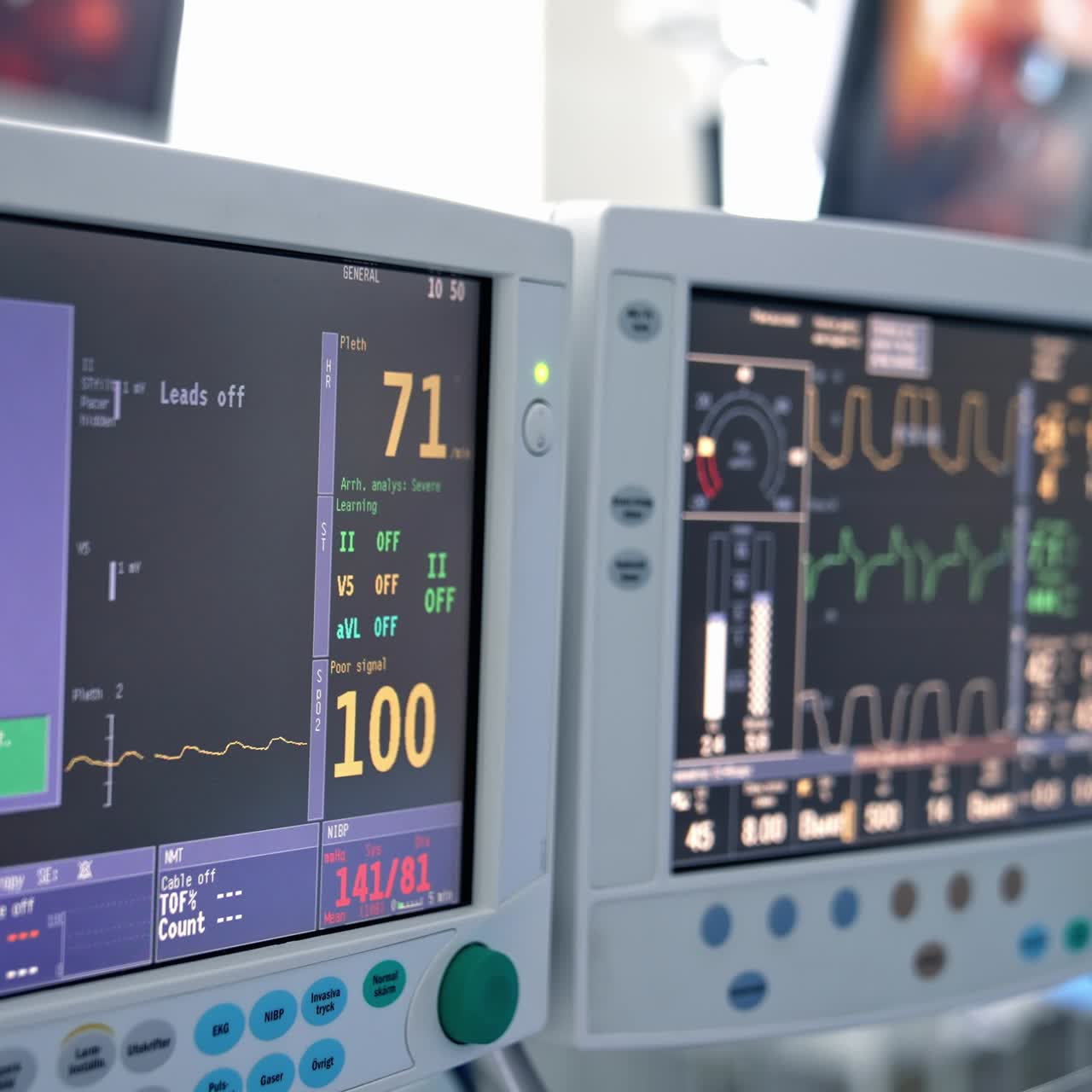 Monitors in hospital theater. Medical vital signs monitors in a hospital. Anesthesia surgery monitor. Heart beat of a patient on the screen of computers in hospital