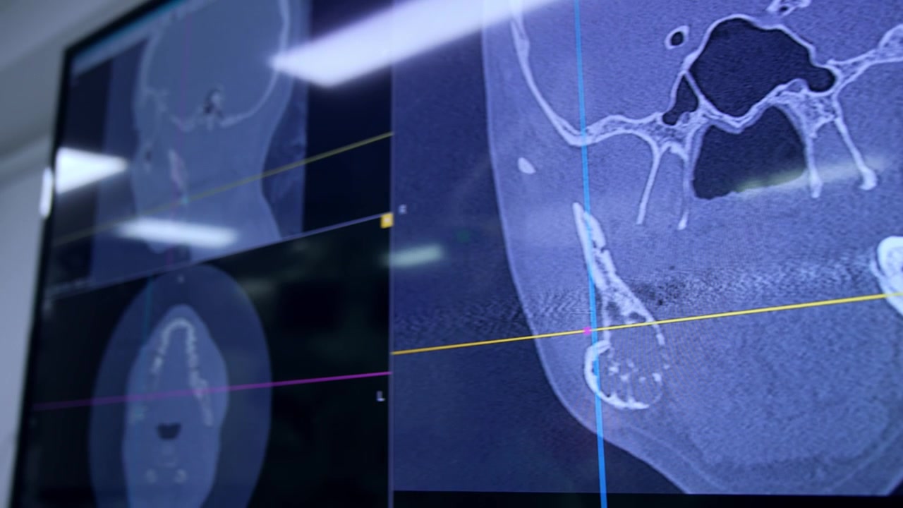 Head MRI scans of the patient at the monitor of equipment. Close up. Preparation for maxillofacial surgery.