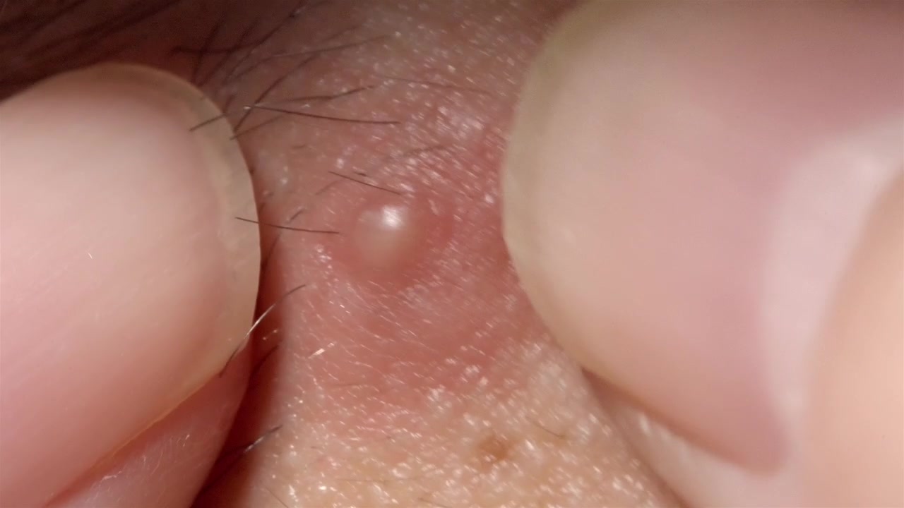Macro di spremitura di un brufolo sulla pelle umana in primo piano