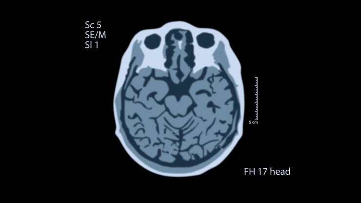 Ressonância magnética cerebral. Uma visualização na tela preta. Fundo médico 4K
