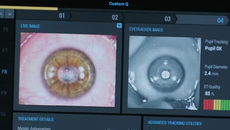 ophthalmic surgery. view on the screen of medical monitor in operating room. lasik