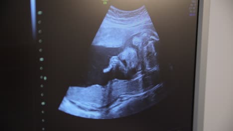 a of ultrasound of the fetus under the diagnosis of a pregnant woman on the monitor. a of ultrasound of the fetus under the diagnosis of a pregnant woman on the monitor screen. pregnancy screening. fetal movements during ultrasound
