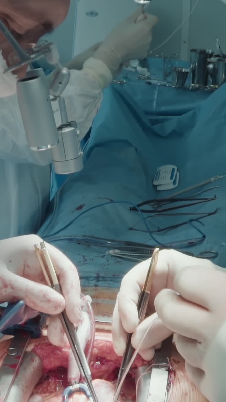 кардиоторакальные хирурги оперируют пациента. квалифицированные медики используют эндоскопические приборы для пересадки извлеченных сосудов, создавая новый путь для кровотока.