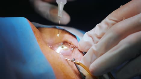 레이저 시력 교정: 안과 수술 중에 수술실에 있는 환자와 수술팀; 눈꺼풀 스럼; 라식 치료; 불임 개 아래의 환자
