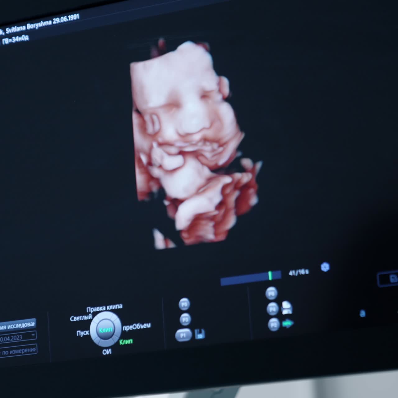 Rendering in 3D di un'immagine fetale sullo schermo di un ecografo. Controllo dello sviluppo del bambino