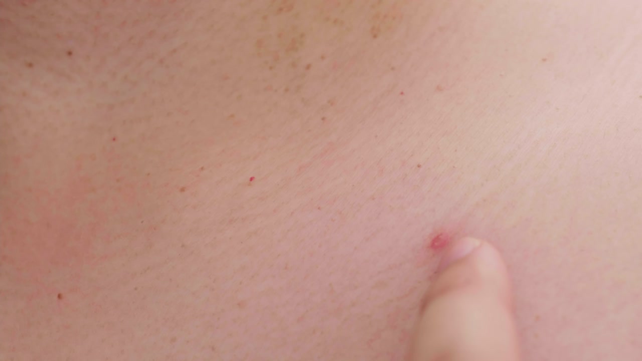 피부 문제 여드름과 큰 못생긴 간단한 클로즈업