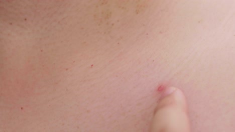 Skin-problems-acne-and-big-ugly-simple-close-up