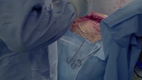 cardiosurgeons perform a cut with the help of a coagulator aorto-coronary bypass surgery is performed