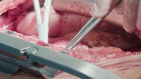 surgeon uses tools during heart operation. doctor ensures meticulous attention to detail and patient safety during coronary artery bypass surgery