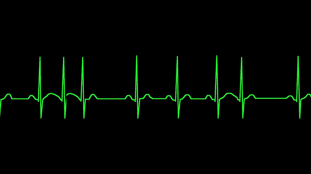 el ecg muestra arritmia sinusal