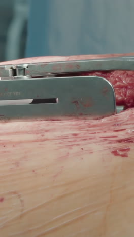 el cirujano prepara el pecho con una herramienta médica. el médico expande el pecho del paciente con un dilatador quirúrgico. área de preparación para una intrincada cirugía de derivación de la arteria coronaria.