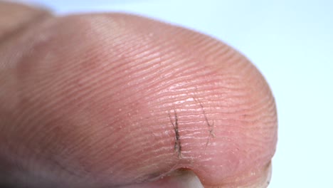 Dry-cut-wound-on-human-Index-finger-extreme-closeup