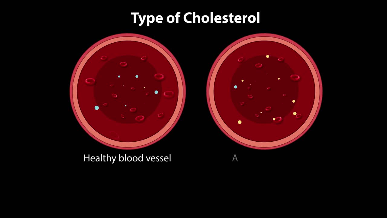건강한 혈관과 동맥경화 혈관의 비교