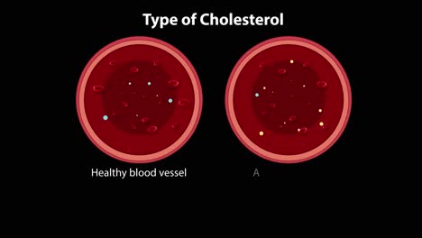 comparison of healthy and atherosclerotic blood vessels