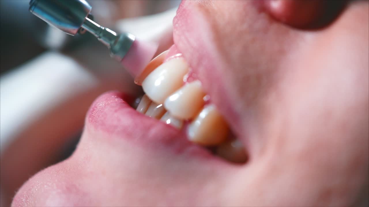 Dental Procedure - Teeth Polishing