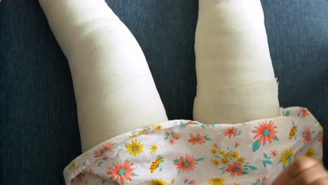 niño pequeño con vendaje de yeso en la pierna