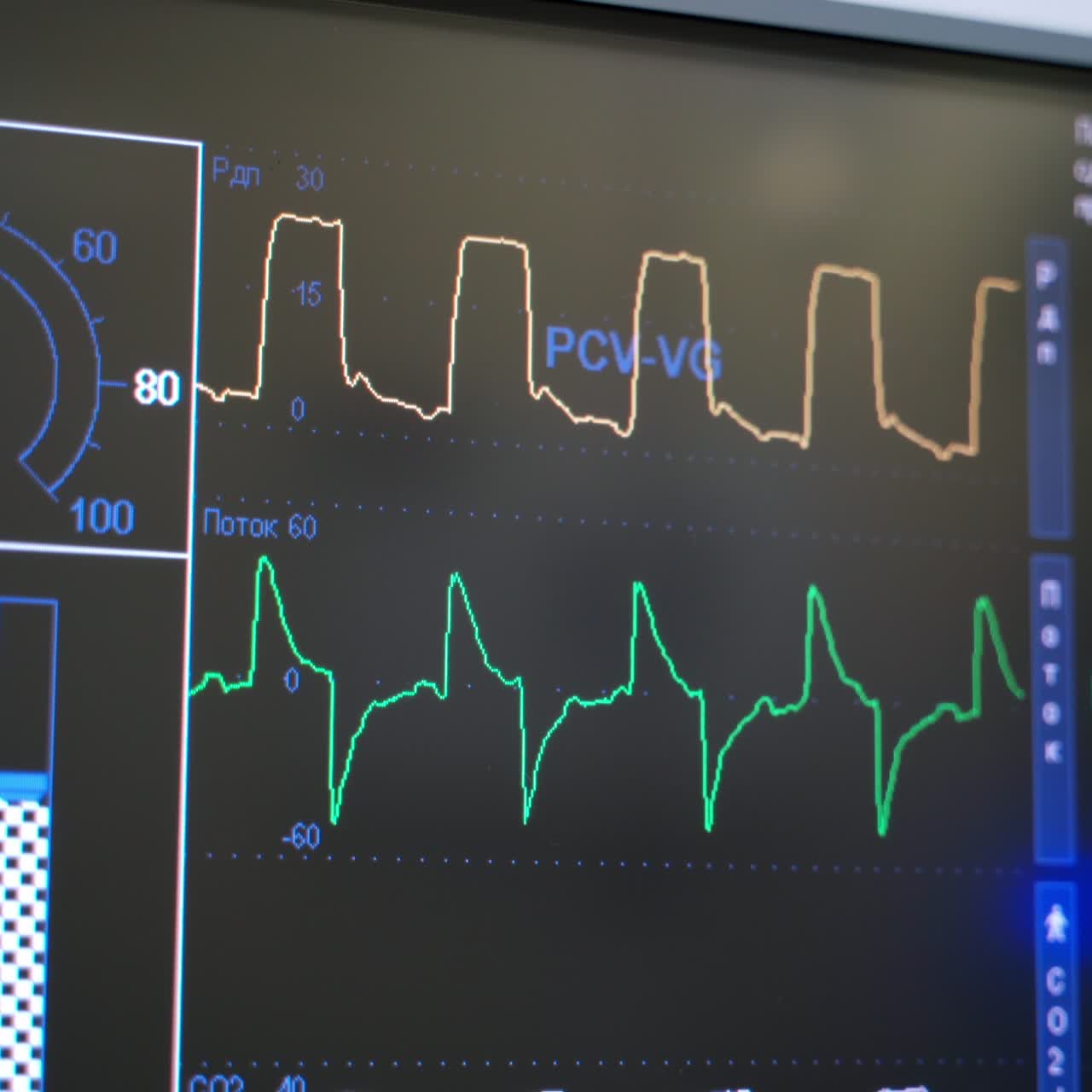Artificial lung ventilation monitor in the intensive care unit. Hospital, surgical operating room. Life saving. Ventilation of the lungs with oxygen.