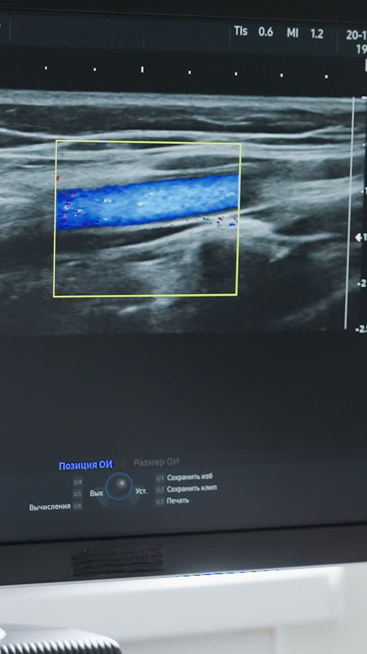 caucasian female patient viewing Doppler monitor closeup ear and neck silhouette, monitor displays color flow within carotid artery, clinician explains findings, sonographer adjusts probe