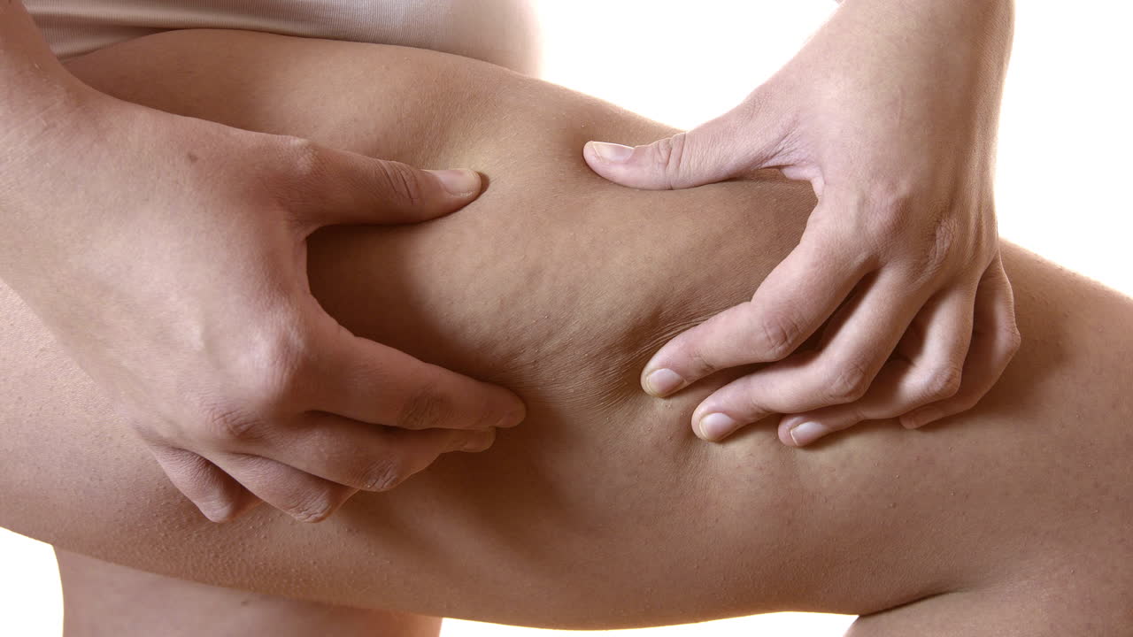 Close-up on the thigh of a fat woman squeezing her thigh to show cellulite. Dangerous adipose tissue building up on female's leg as a result of unhealthy eating habits and slow metabolism