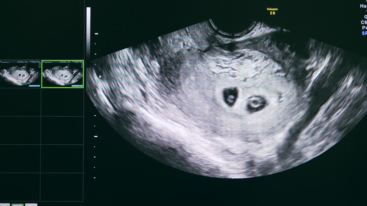 imagen en blanco y negro en la pantalla ultrasónica