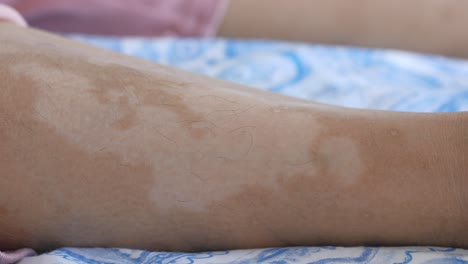 skin pigmentation patch on leg