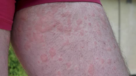 cerca de un brote de urticaria en la pierna del hombre caucásico