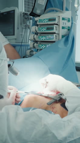 el cirujano y el anestesista trabajan en la operación cardíaca. los especialistas médicos realizan una complicada cirugía de derivación de la arteria coronaria para el paciente en el hospital