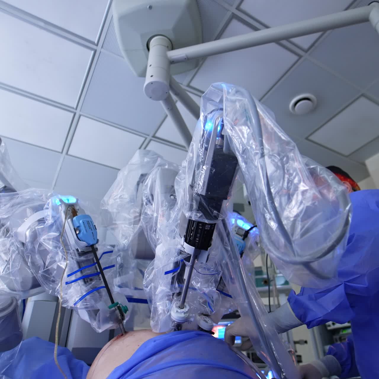 Innovative Da Vinci robot performing laparoscopic operation. Male surgeon uses long instrument alongside with robotic equipment. Low angle view