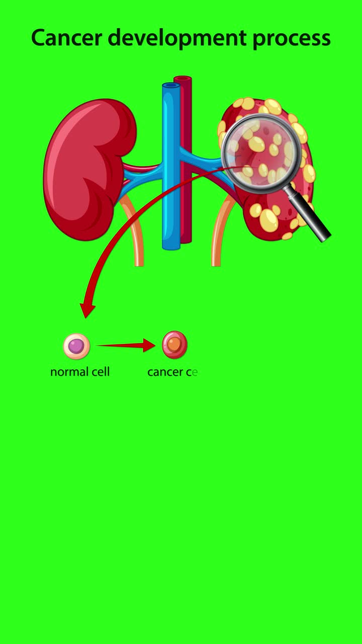 Medical animation showing kidney cancer progression, tumor growth, cell mutation, and malignant proliferation