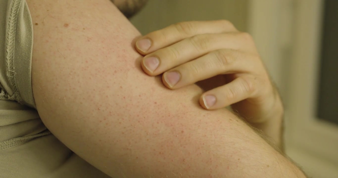 Close-up of a person scratching the upper arm, illustrating skin irritation, itching, discomfort, allergy symptoms, and dermatological health concerns.