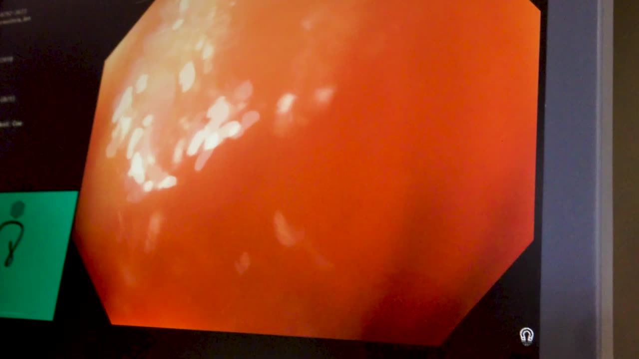 cámara médica filmando dentro del estómago