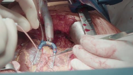 surgeon hands with tools operate patient. procedure to treat coronary artery disease with grafting harvested vessels to divert blood supply closeup