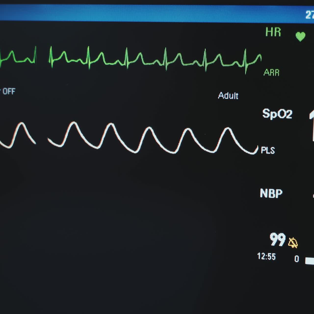 Black screen with two wavy lines running. Monitor with patient's vital signs of an operated patient. Close up