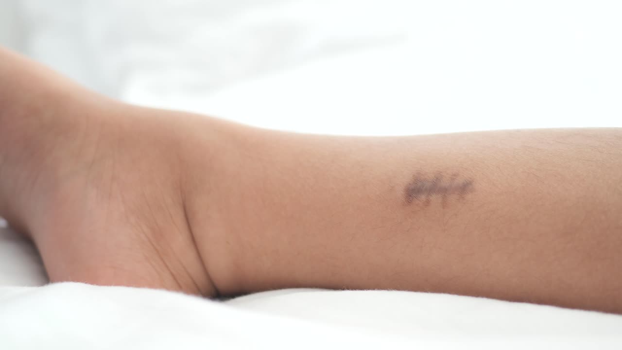 un primer plano de una cicatriz en la pierna de una persona