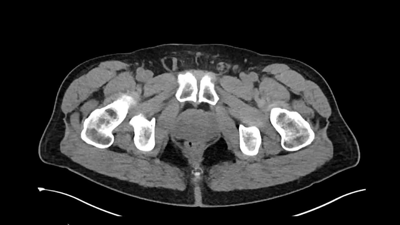 복부 고양이 스캔 상단 뷰