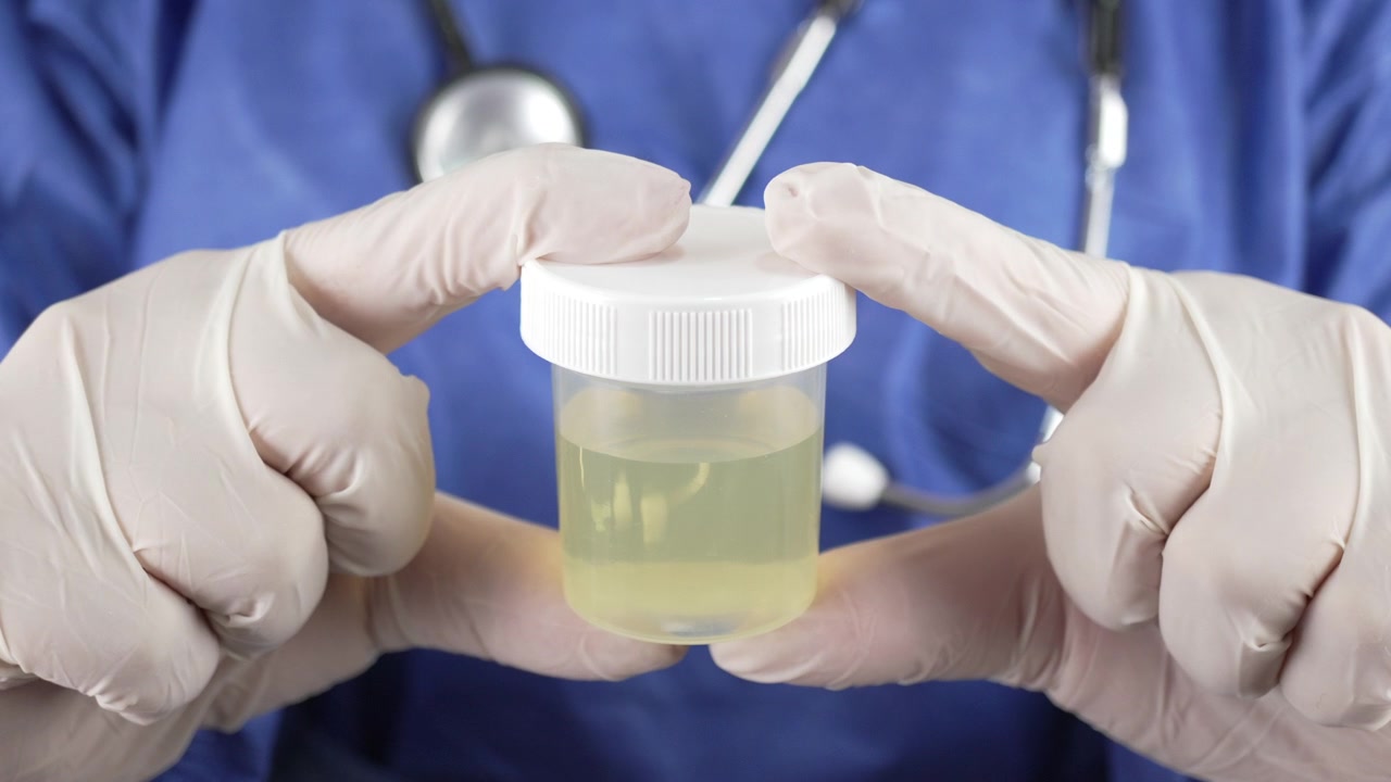 Operatore sanitario con camice blu e guanti tiene in mano un contenitore trasparente per campioni di urina verso l'obiettivo, utile per test di laboratorio, diagnostica e temi di controllo delle infezioni.