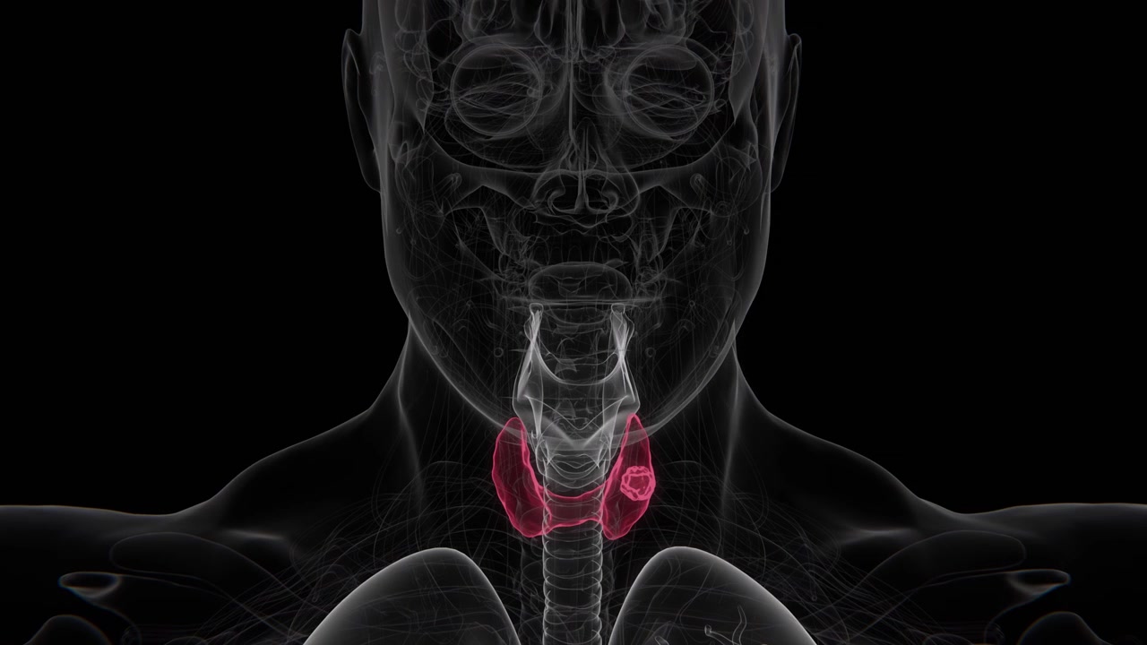 Il cancro alla tiroide è un tumore maligno che origina dalle cellule della ghiandola tiroidea, un organo che produce ormoni situato nella parte anteriore del collo, in 4K UHD