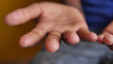 hands with dry, rough skin