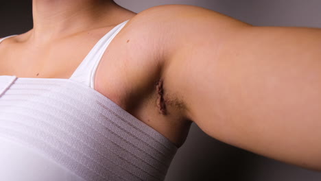 close up of females armpit scar post transaxillary breast augmentation