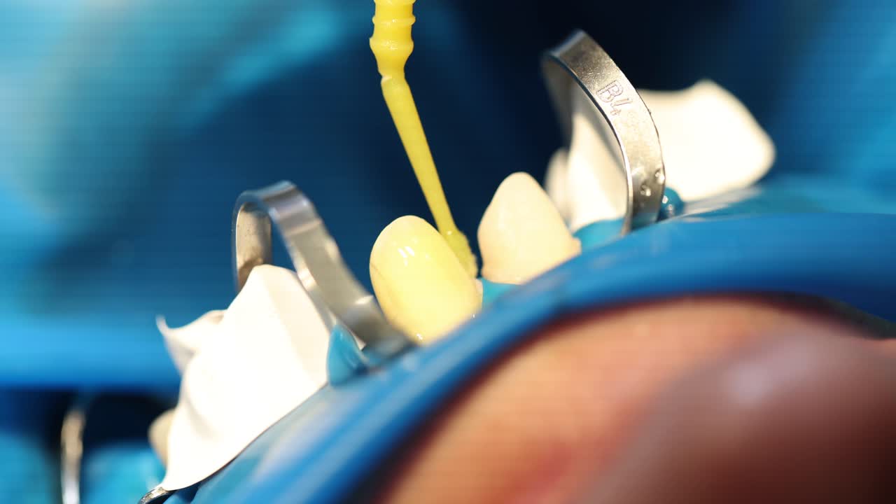 Usage of special dental photopolymer filling and yellow stick