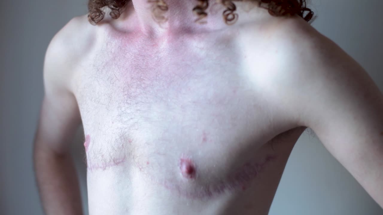 Transgender Man showing Surgery Scars on Chest