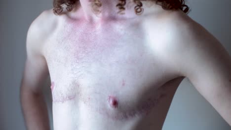 transgender man showing surgery scars on chest