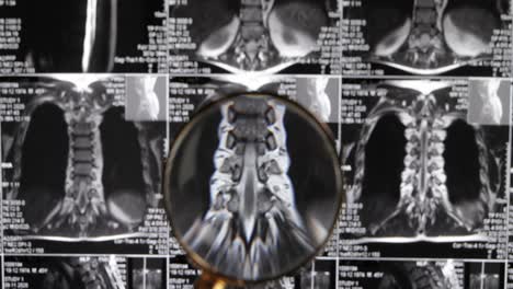 resonancia magnética de fondo de la columna lumbar, tomografía por resonancia magnética. el médico examina la resonancia magnética de la columna lumbar con discos pellizcados de la columna vertebral y los nervios.