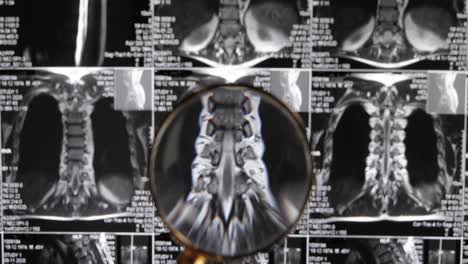 mri lumbar spine background, magnetic resonance tomography. doctor examines mri of lumbar spine with pinched discs of spine and nerves.