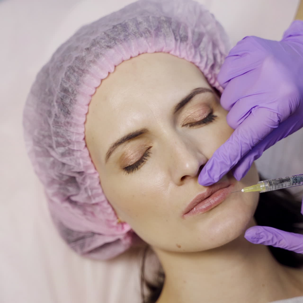 A beautician in gloves makes botox injections to the upper and lower parts of the lips of a young woman. Close-up.