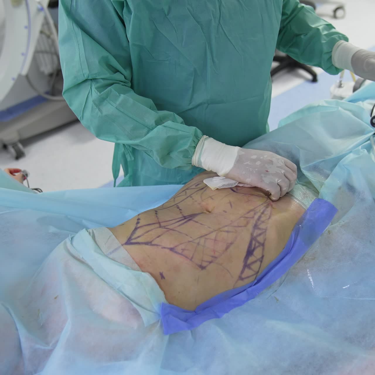Process of liposuction surgery. Doctor removes fat from patients belly on the operating table. Surgeon perform plastic surgery. Top view