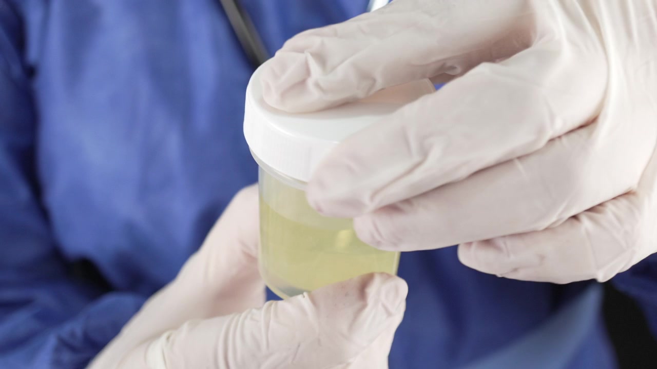 Medical professional wearing gloves closes a plastic urine sample container against a blue scrub background, showing clinical testing and diagnostics.