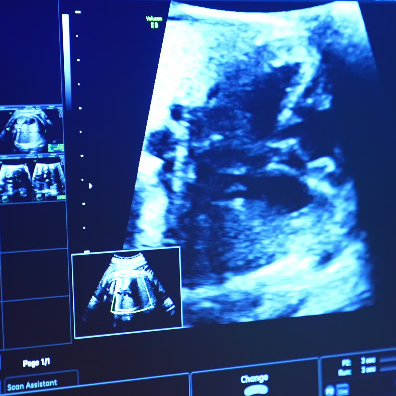 Schermo blu di un ecografo che mostra l'addome di una donna incinta. Medico che controlla la gravidanza