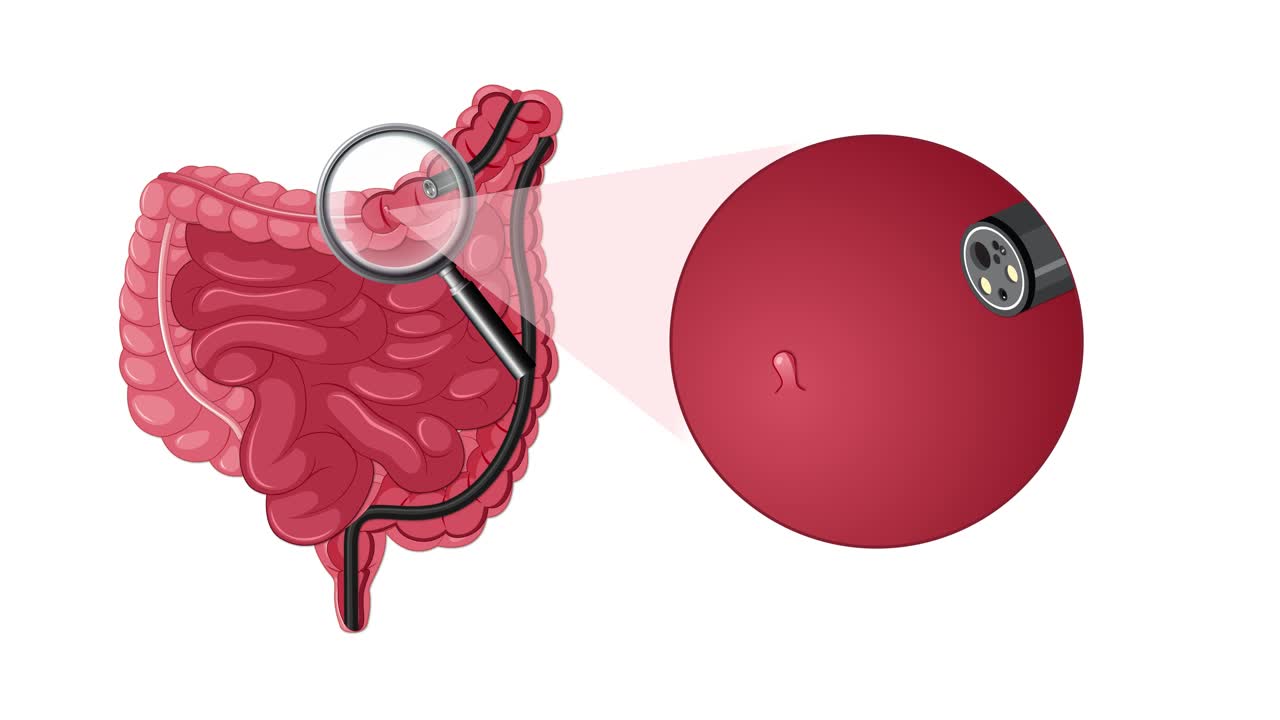 Medical animation illustrating endoscopic surgery on colon using magnification and specialized surgical tool