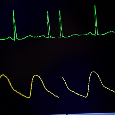 heart monitor in hospital theatre. monitor heart rate for surgery in operate room